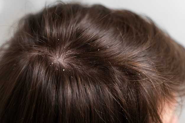 Способы лечения жирной себореи кожи головы