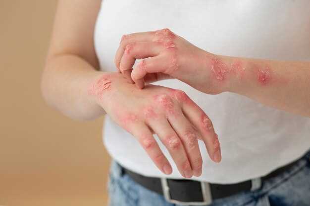 Симптомы аллергии на руке